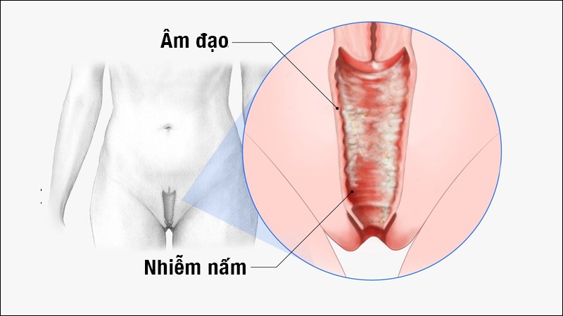 khí hư vón cục nguyên nhân và cách điều trị