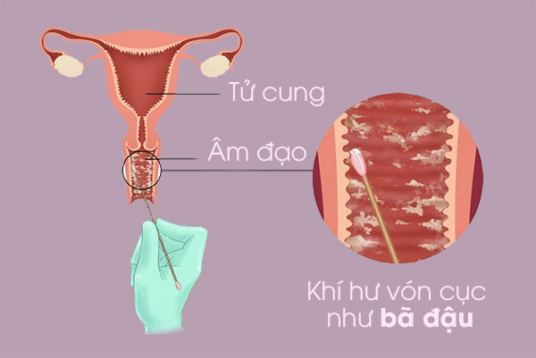 khí hư vón cục như bã đậu