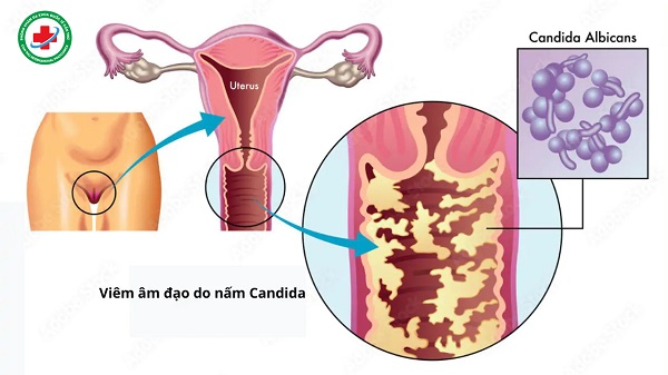 nấm âm đạo