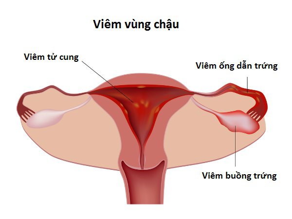 viêm vùng chậu